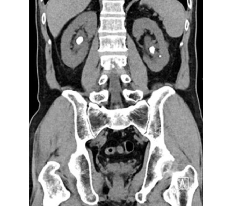 Kidney Stone Tan Tock Seng Hospital
